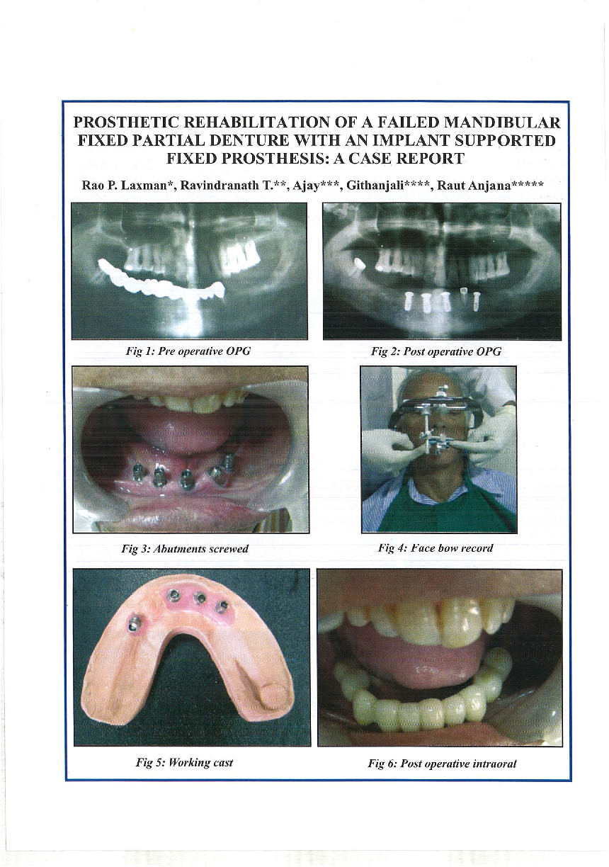 Prosthetic rehabilitation of a failed mandibular fixed partial denture with an implant supported fixed prosthesis: A case report