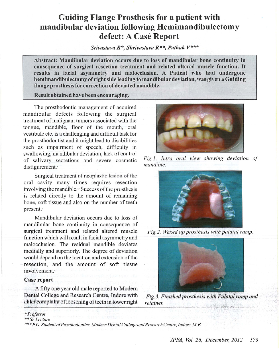 Guiding Flange Prosthesis for a patient with mandibular deviation following Hemimandibulectomy defect: A Case Report