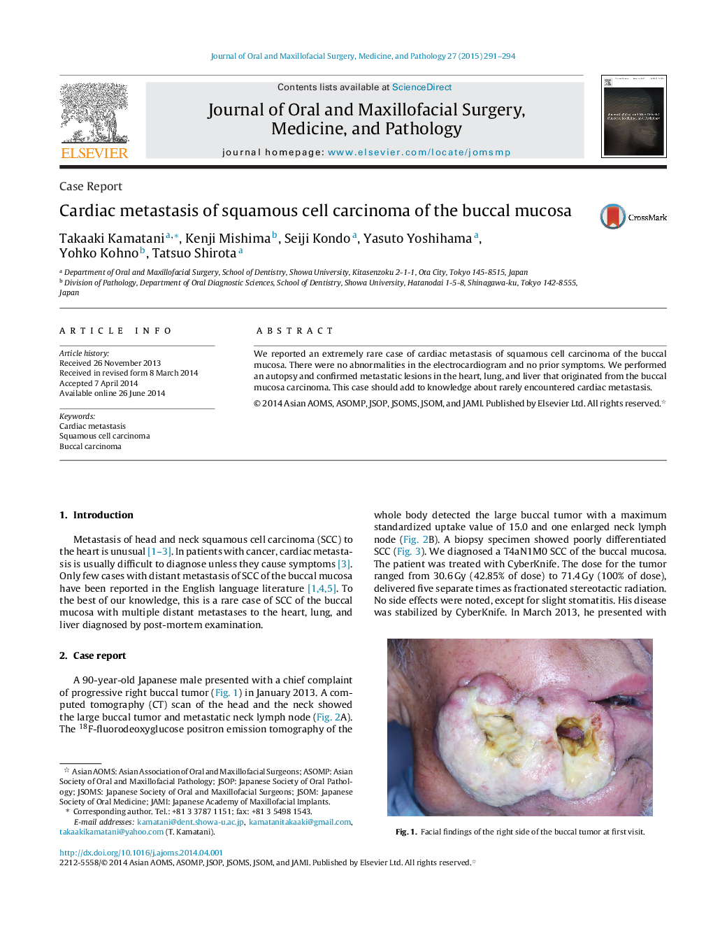 Cardiac metastasis of squamous cell carcinoma of the buccal mucosa 