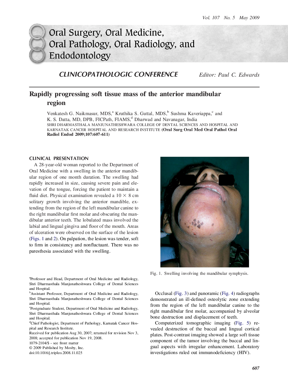 Rapidly progressing soft tissue mass of the anterior mandibular region