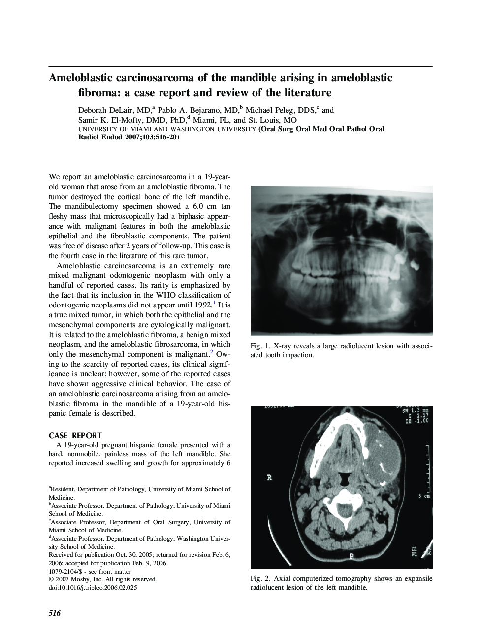 Ameloblastic carcinosarcoma of the mandible arising in ameloblastic fibroma: a case report and review of the literature