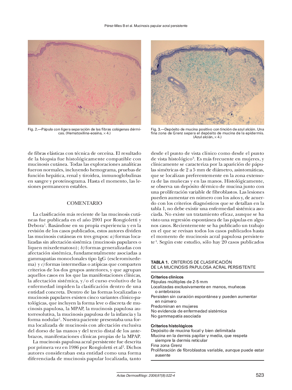 Angiosarcoma sobre linfedema crónico