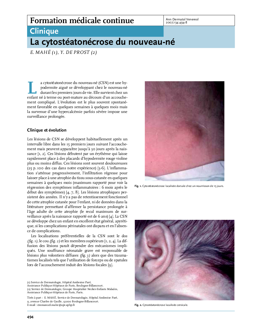 عکس صفحه اول مقاله: La cytostéatonécrose du nouveau-né La cytostéatonécrose du nouveau-né