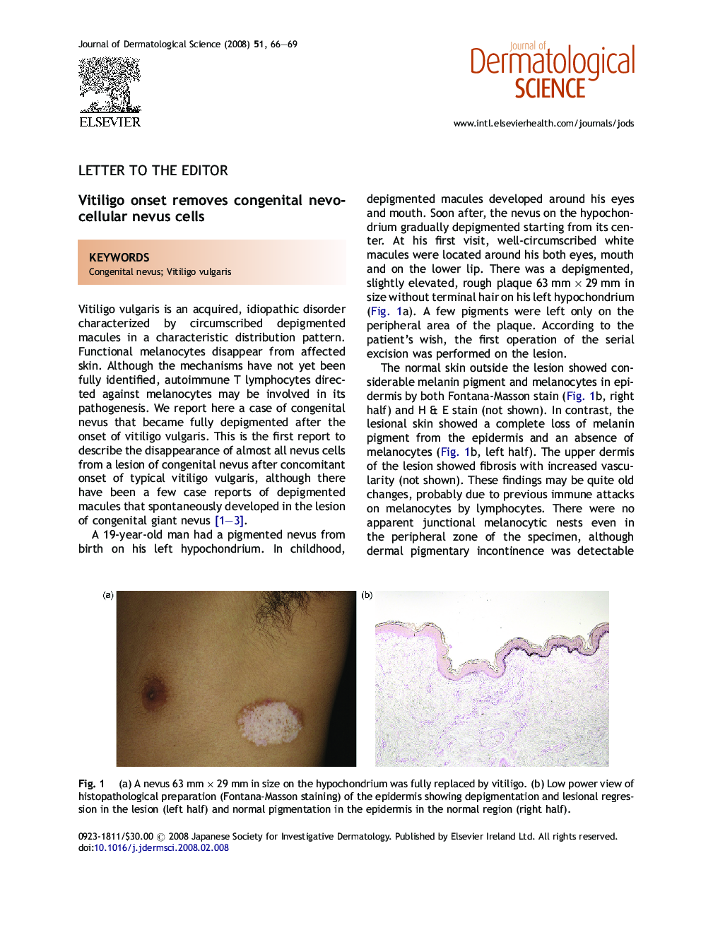 Vitiligo onset removes congenital nevocellular nevus cells