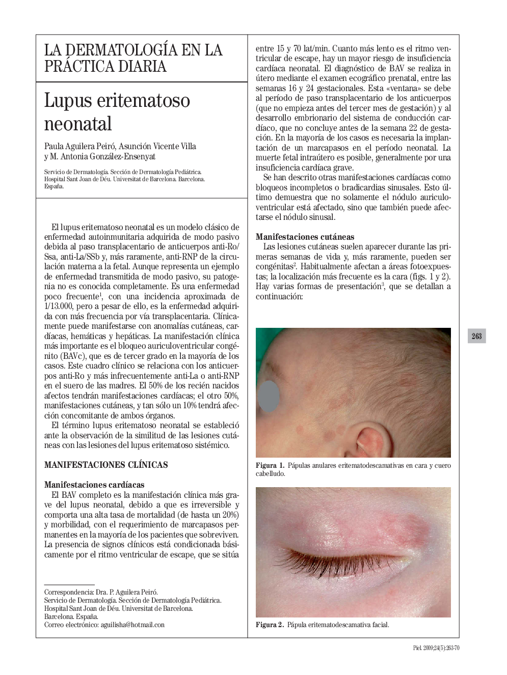 Lupus eritematoso neonatal