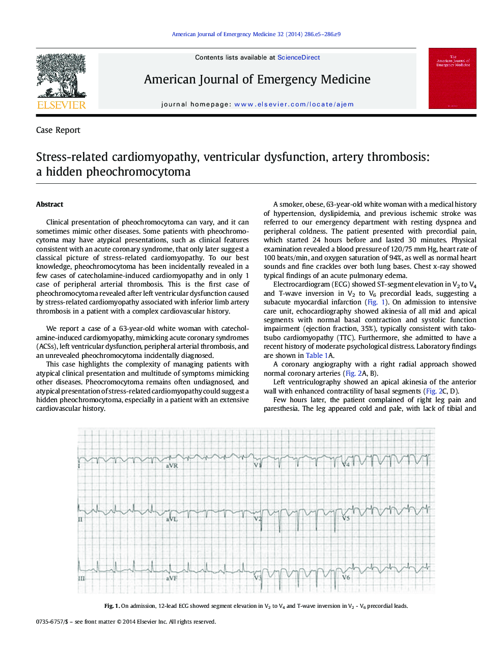 Stress-related cardiomyopathy, ventricular dysfunction, artery thrombosis: a hidden pheochromocytoma