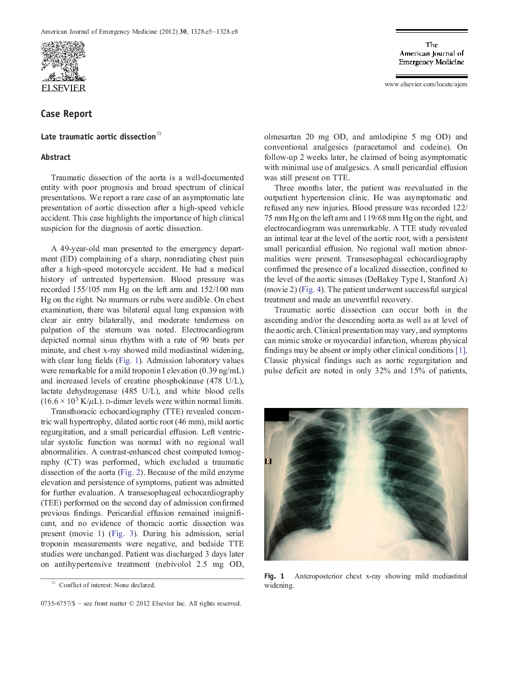 Late traumatic aortic dissection