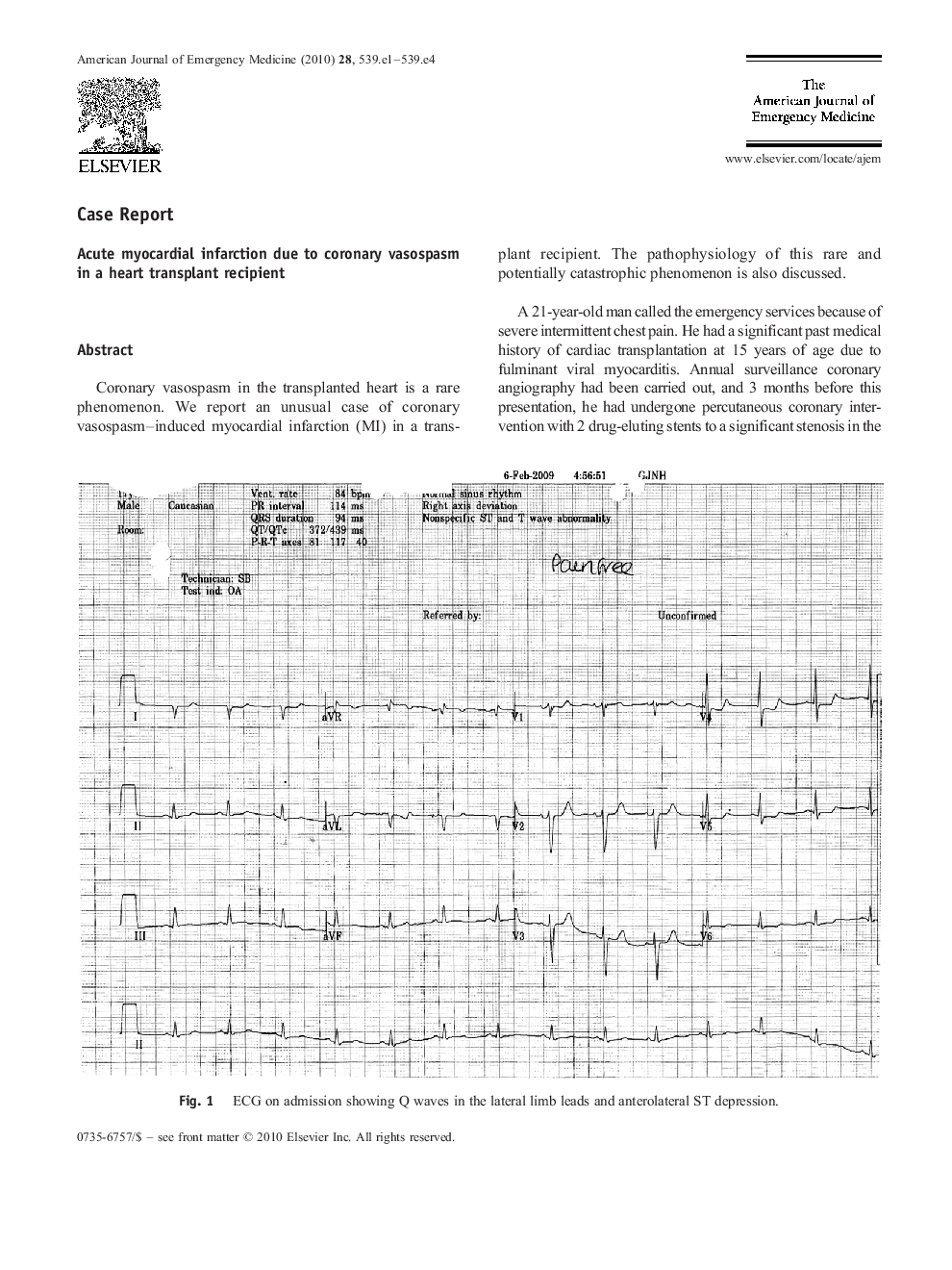 Acute myocardial infarction due to coronary vasospasm in a heart transplant recipient