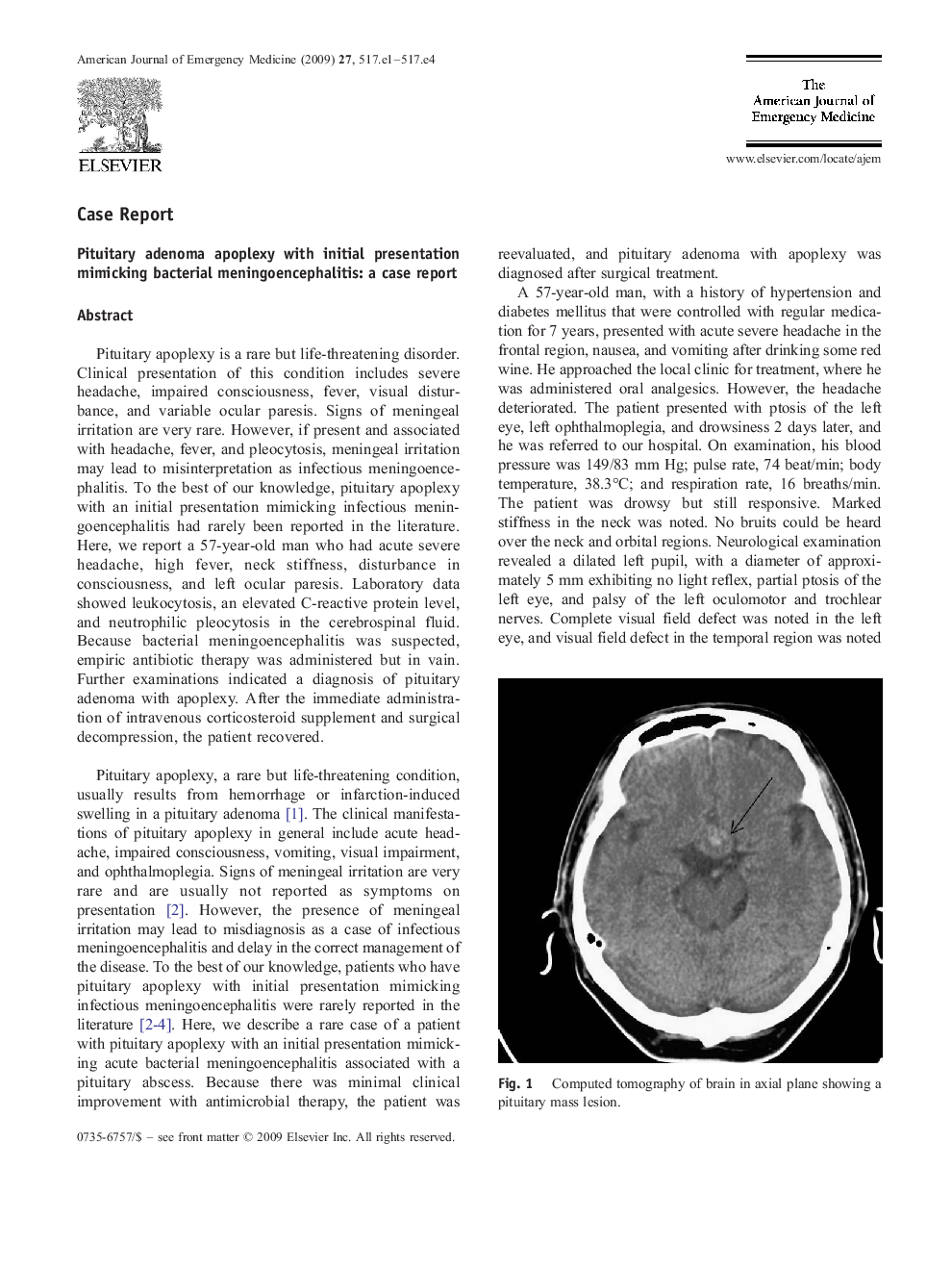 Pituitary adenoma apoplexy with initial presentation mimicking bacterial meningoencephalitis: a case report
