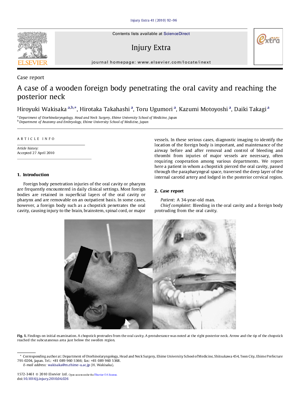 A case of a wooden foreign body penetrating the oral cavity and reaching the posterior neck