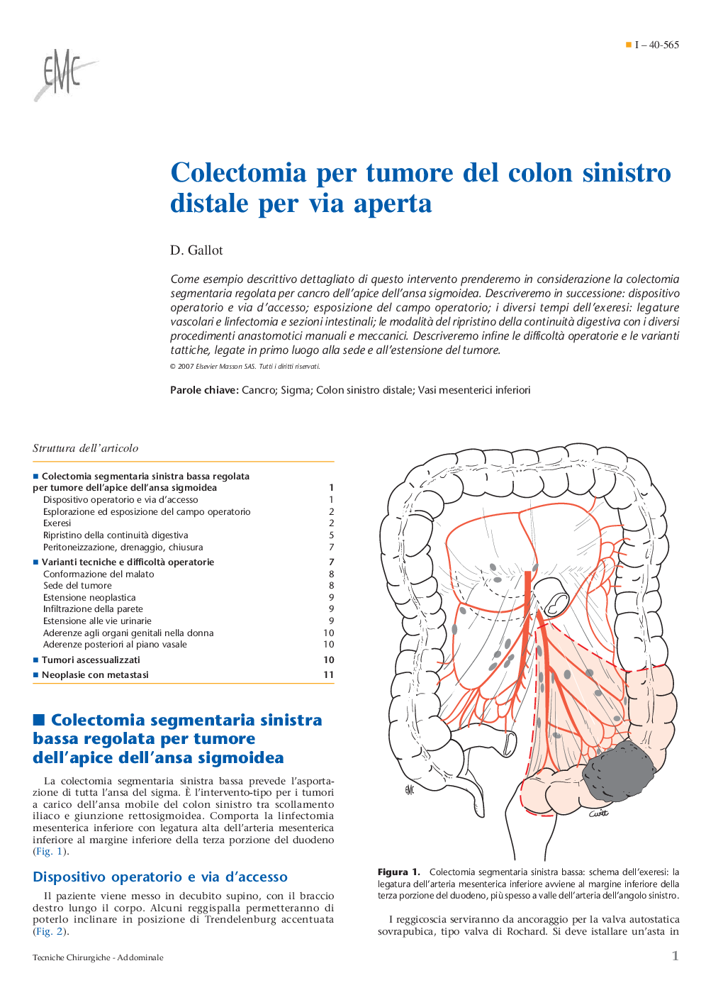 Colectomia per tumore del colon sinistro distale per via aperta