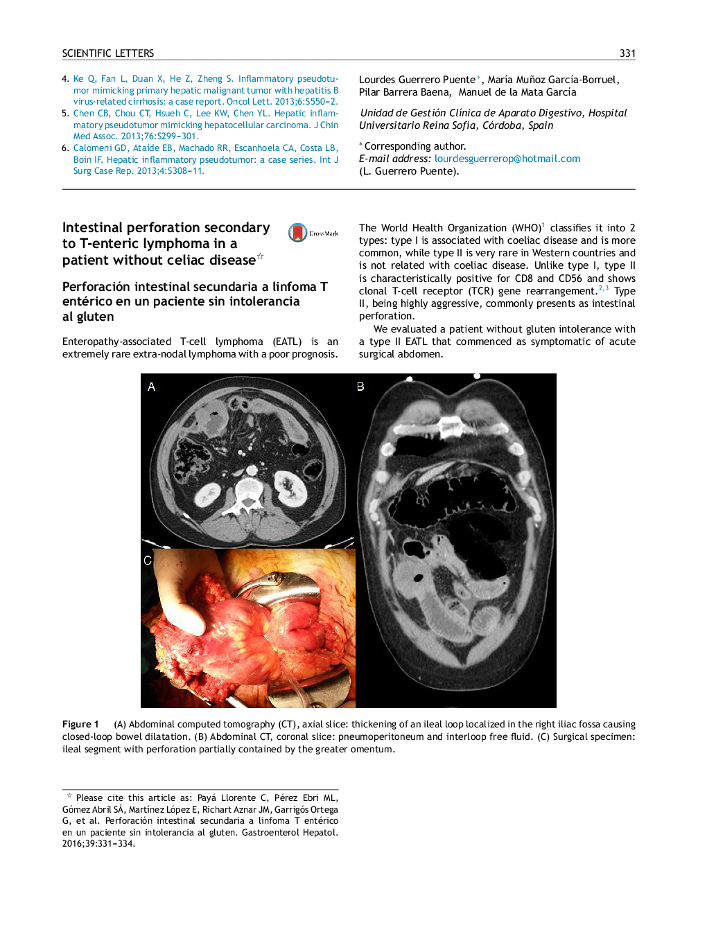 Intestinal perforation secondary to T-enteric lymphoma in a patient without celiac disease