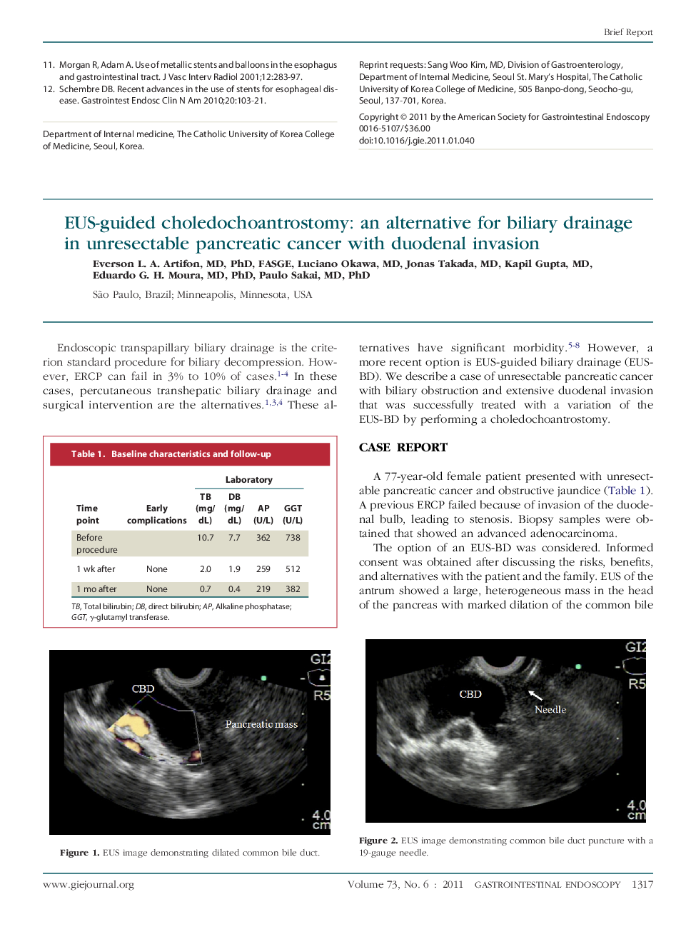 EUS-guided choledochoantrostomy: an alternative for biliary drainage in unresectable pancreatic cancer with duodenal invasion