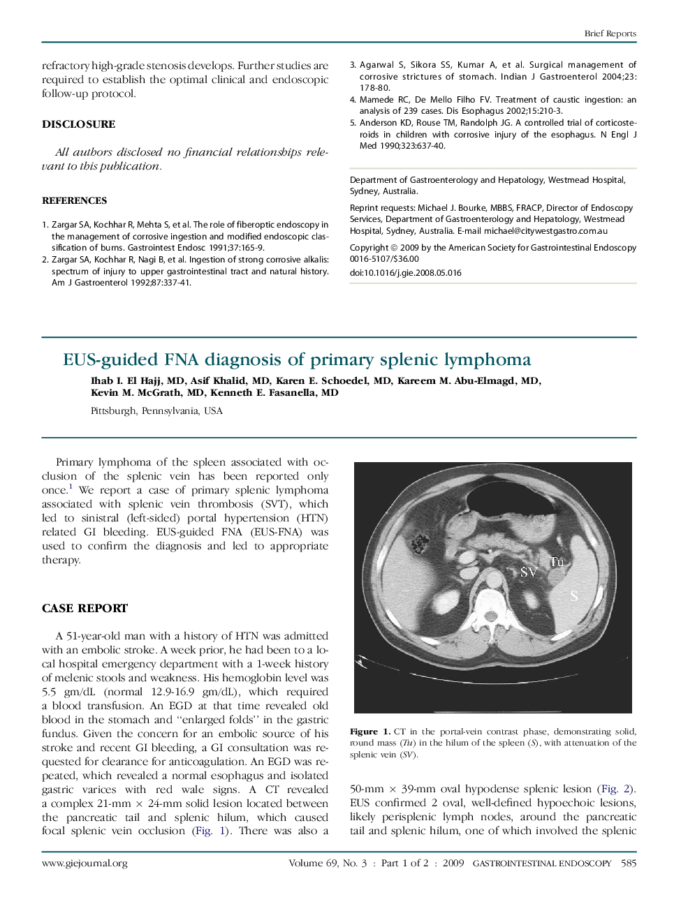 EUS-guided FNA diagnosis of primary splenic lymphoma