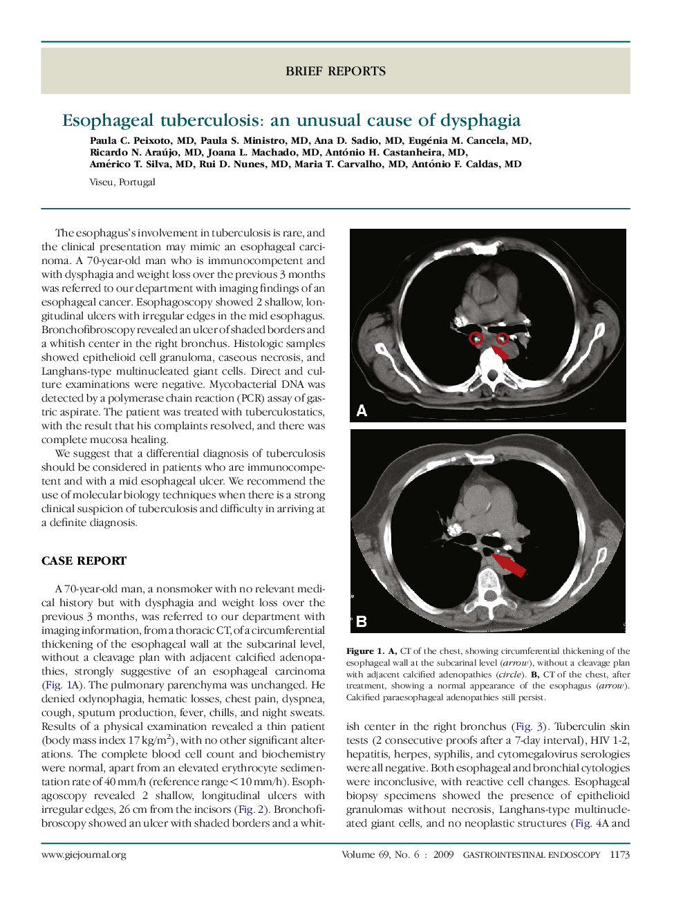 Esophageal tuberculosis: an unusual cause of dysphagia