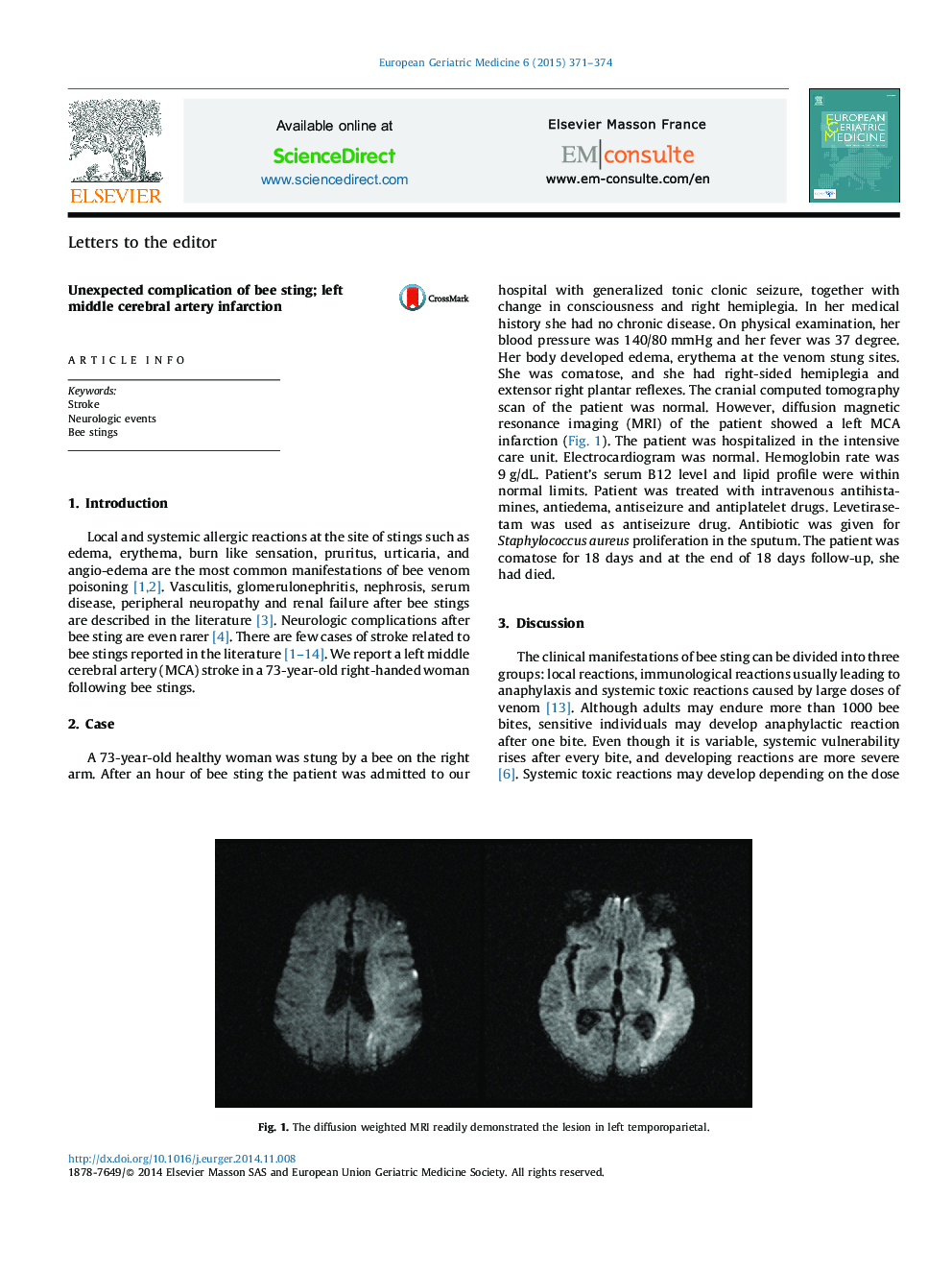 Unexpected complication of bee sting; left middle cerebral artery infarction