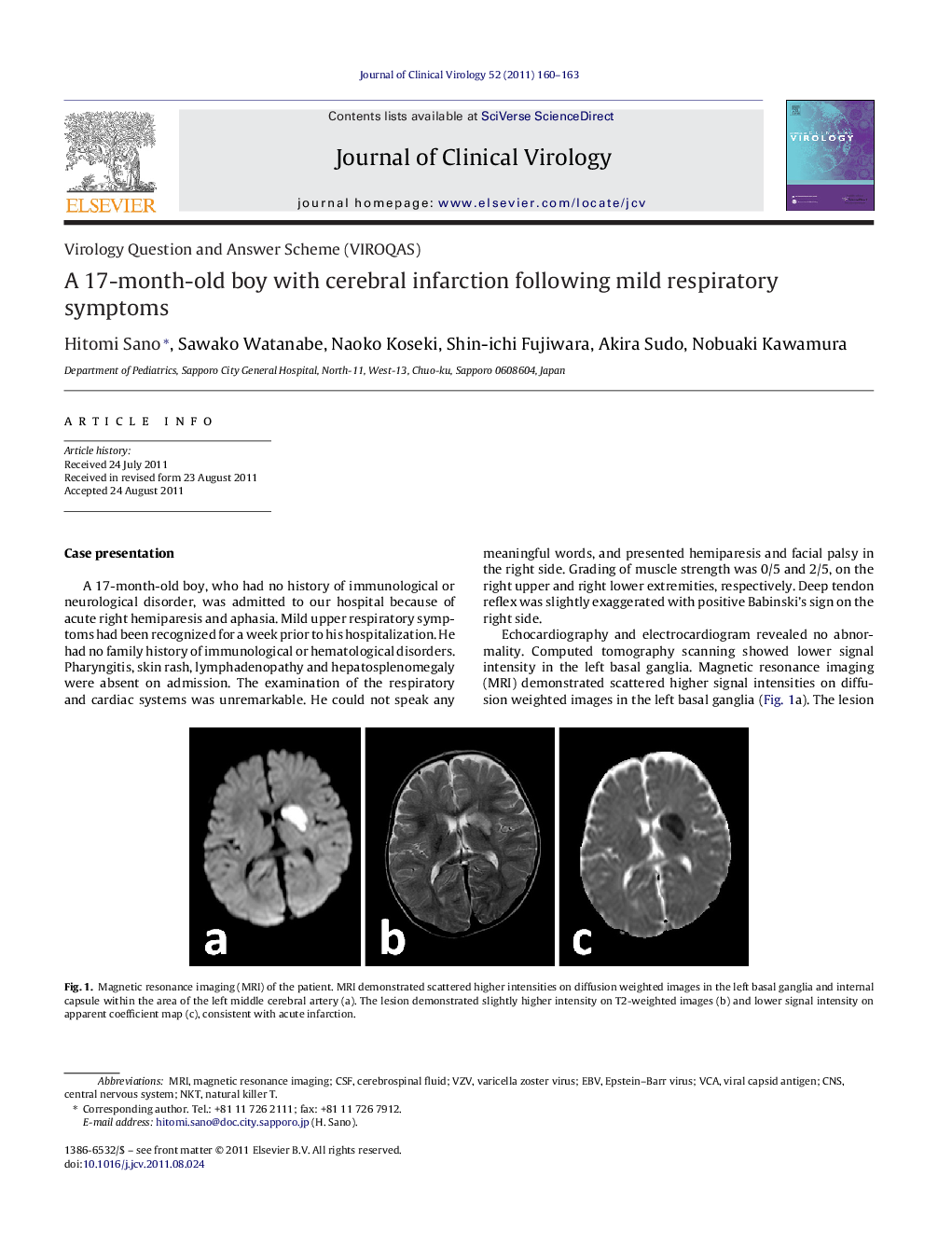 A 17-month-old boy with cerebral infarction following mild respiratory symptoms