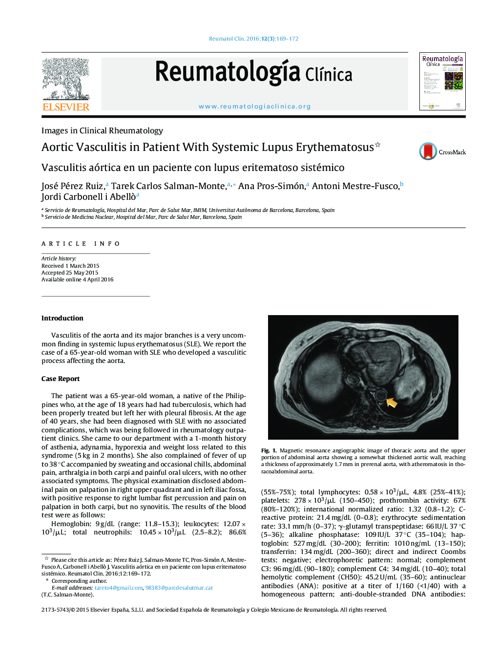 Aortic Vasculitis in Patient With Systemic Lupus Erythematosus