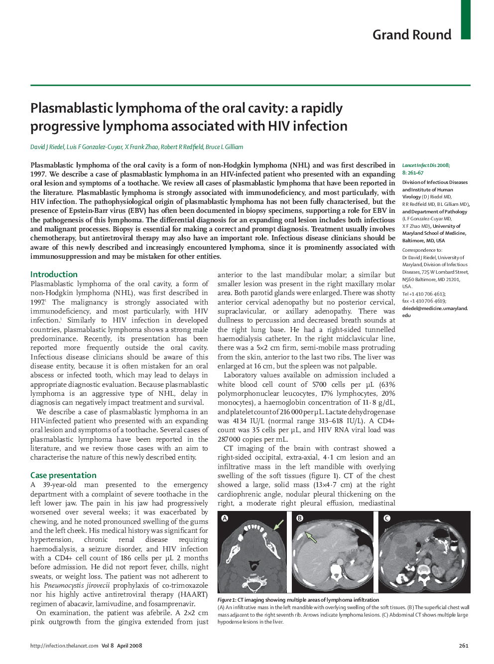 Plasmablastic lymphoma of the oral cavity: a rapidly progressive lymphoma associated with HIV infection