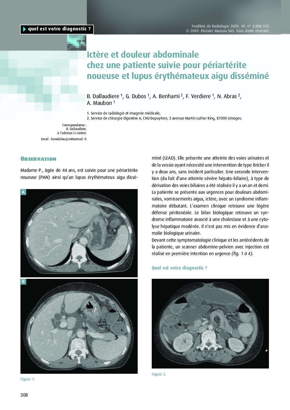 IctÃ¨re et douleur abdominale chez une patiente suivie pour périartérite noueuse et lupus érythémateux aigu disséminé