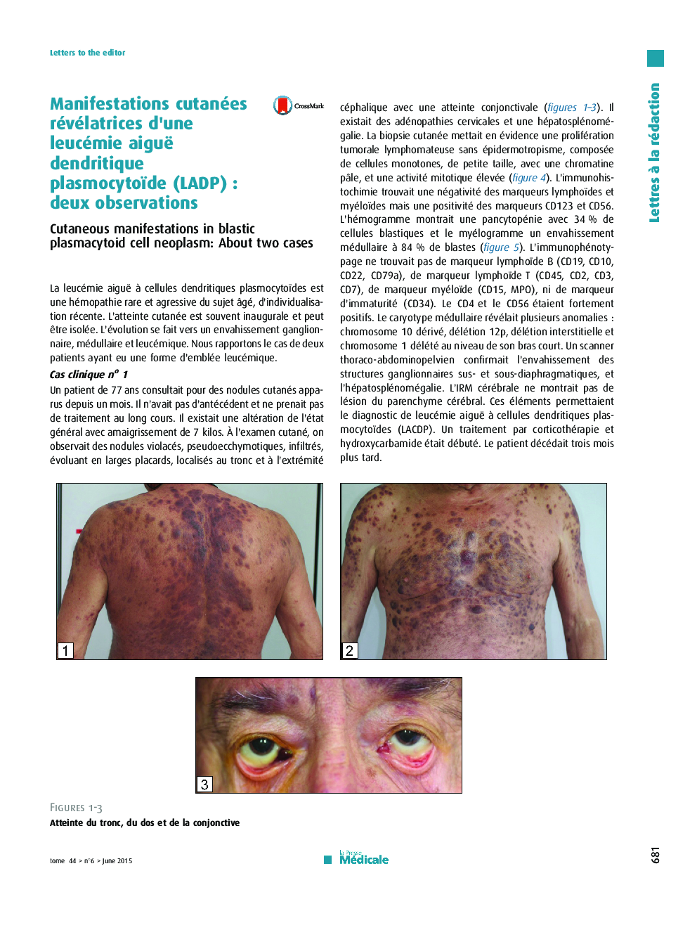 عکس صفحه اول مقاله: Manifestations cutanées révélatrices d'une leucémie aiguë dendritique plasmocytoïde (LADP)Â : deux observations Manifestations cutanées révélatrices d'une leucémie aiguë dendritique plasmocytoïde (LADP)Â : deux observations