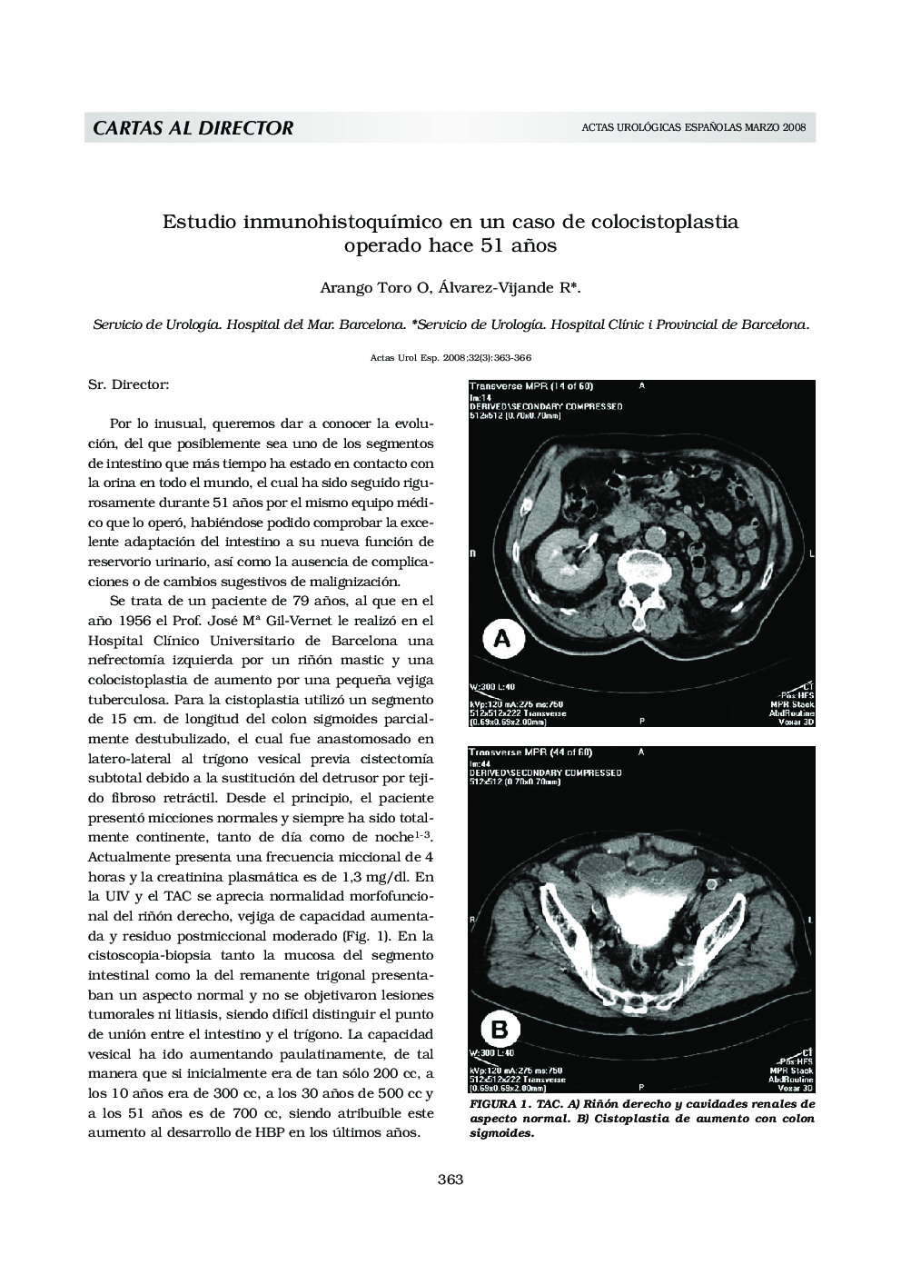Estudio inmunohistoquÃ­mico en un caso de colocistoplastia operado hace 51 años