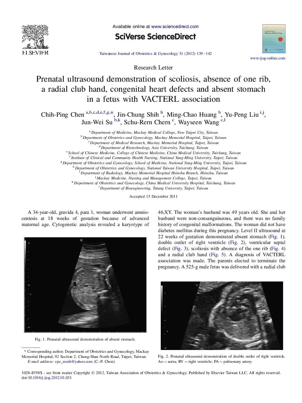 Prenatal ultrasound demonstration of scoliosis, absence of one rib, a radial club hand, congenital heart defects and absent stomach in a fetus with VACTERL association