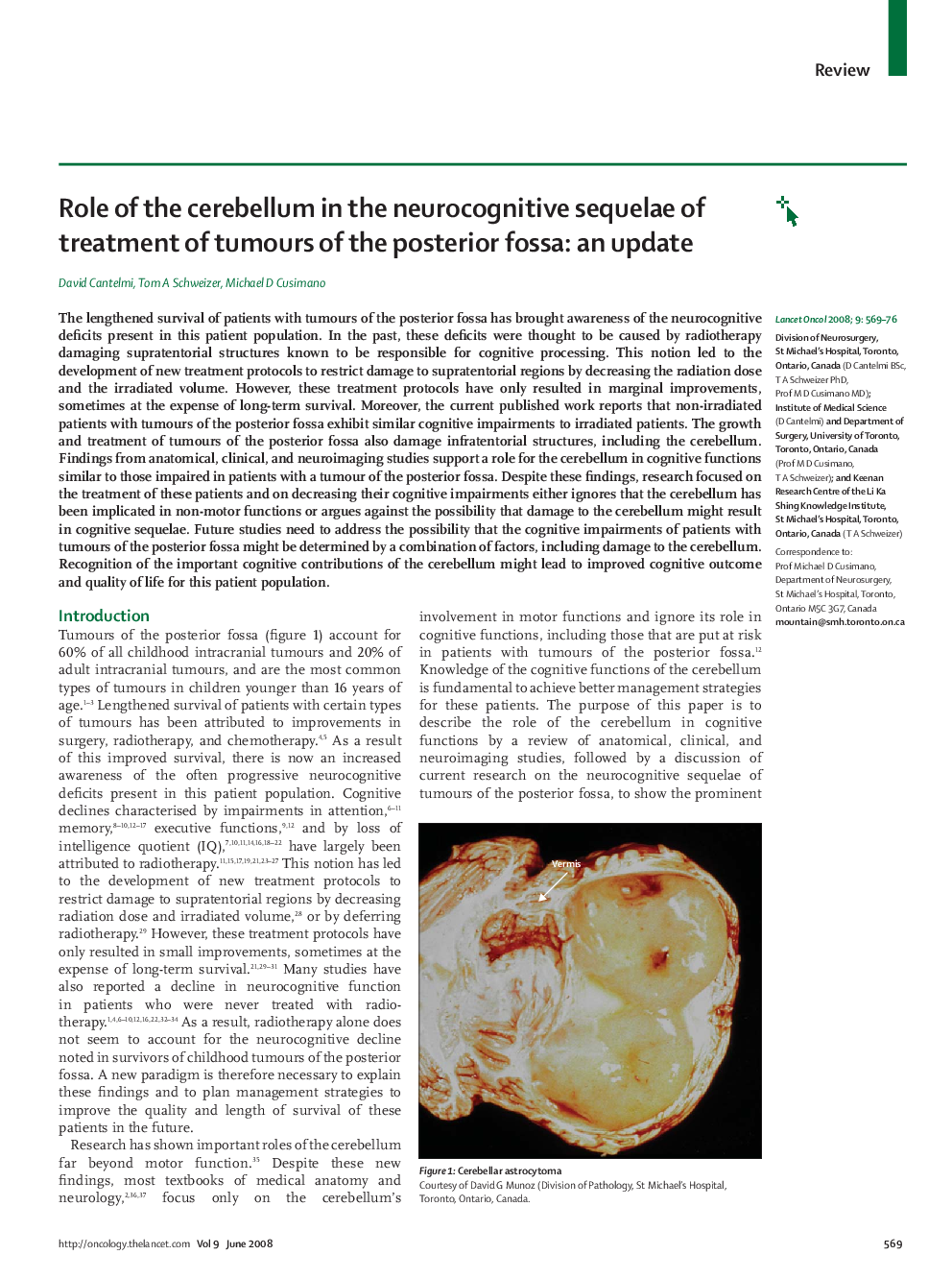 Role of the cerebellum in the neurocognitive sequelae of treatment of tumours of the posterior fossa: an update