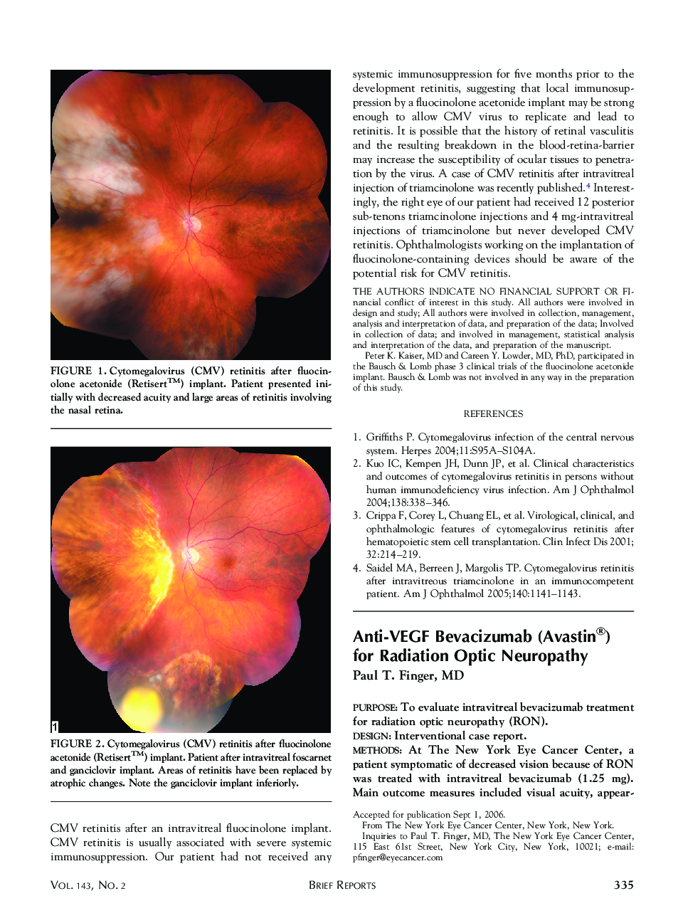Anti-VEGF Bevacizumab (Avastin®) for Radiation Optic Neuropathy 