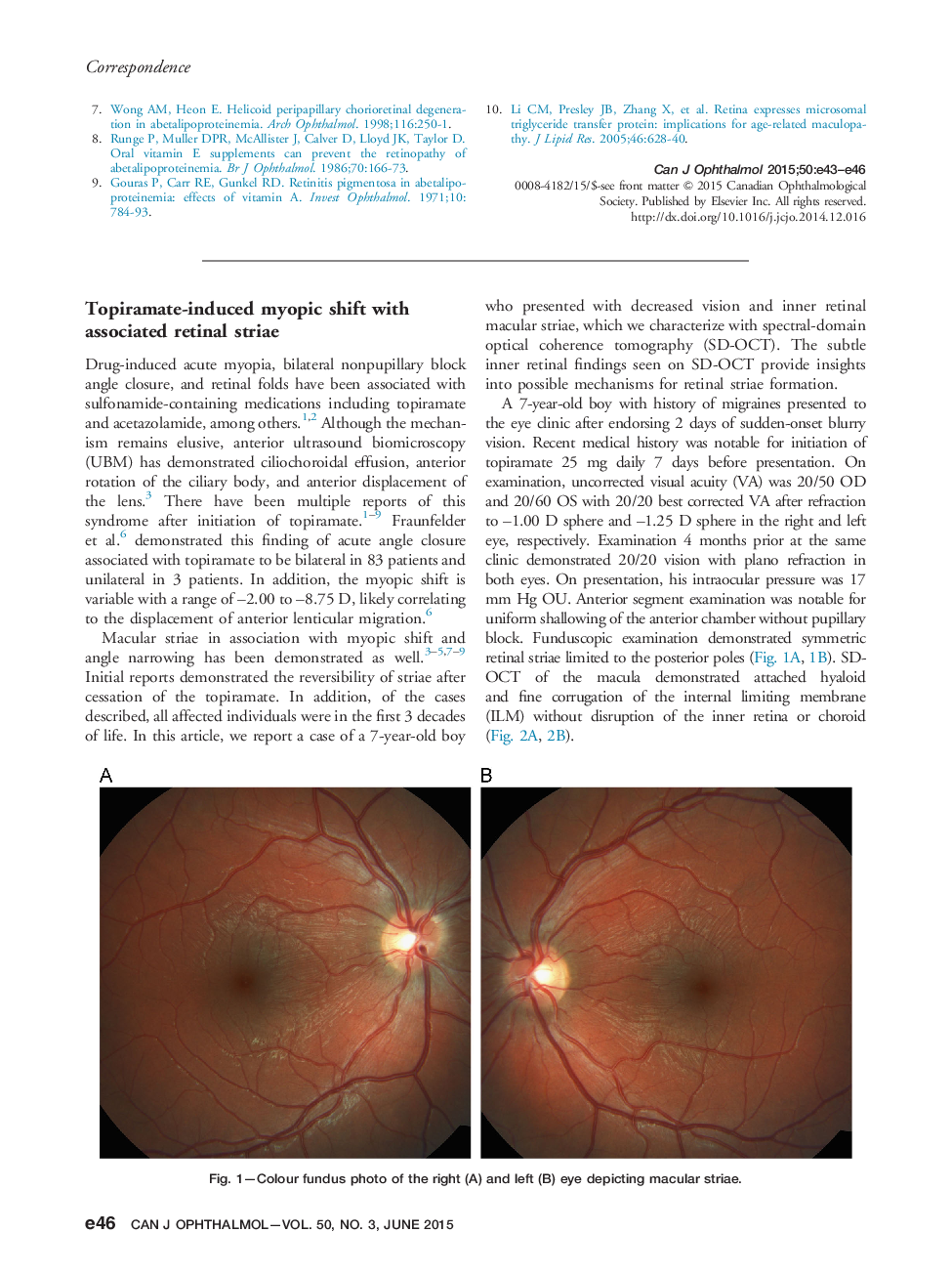 Topiramate-induced myopic shift with associated retinal striae
