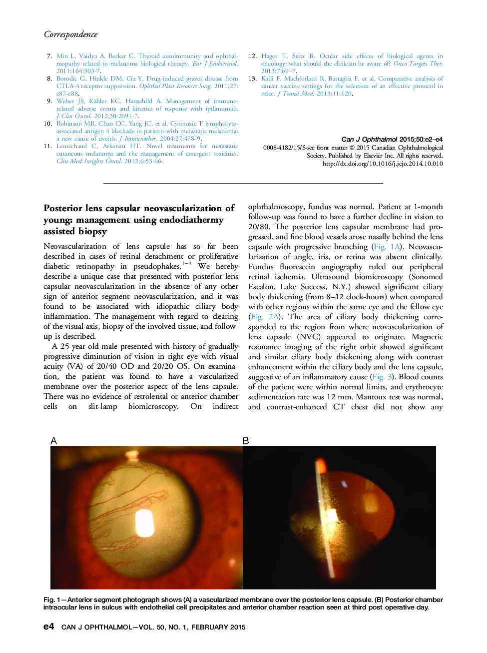Posterior lens capsular neovascularization of young: management using endodiathermy assisted biopsy
