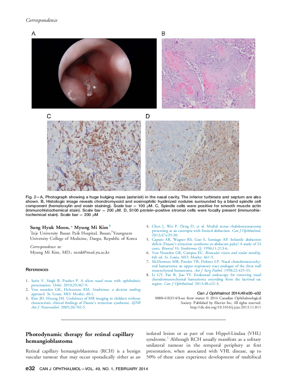 Photodynamic therapy for retinal capillary hemangioblastoma