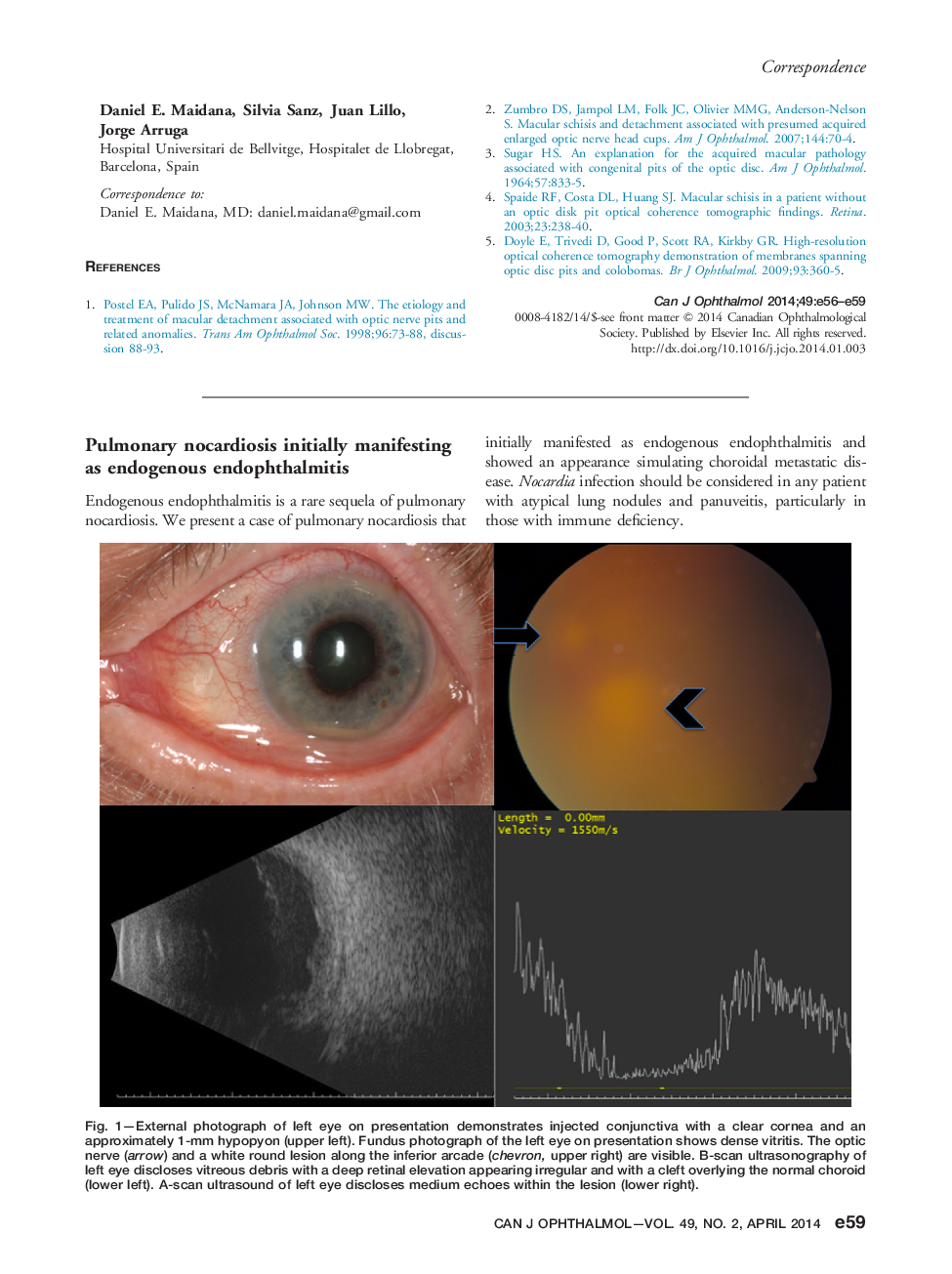 Pulmonary nocardiosis initially manifesting as endogenous endophthalmitis