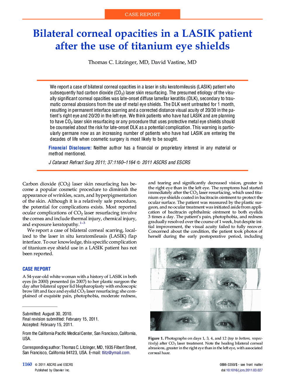 Bilateral corneal opacities in a LASIK patient after the use of titanium eye shields