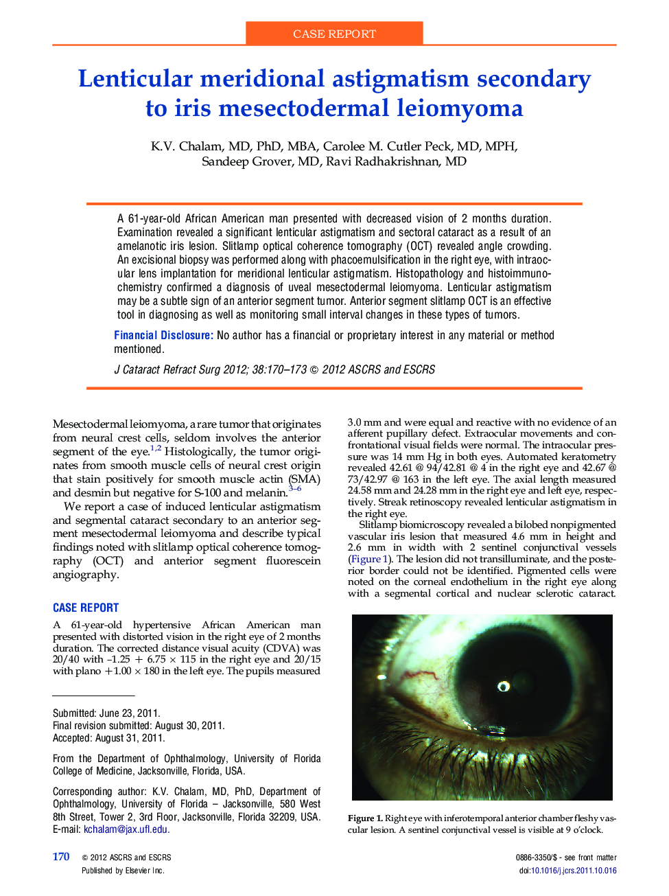 Lenticular meridional astigmatism secondary to iris mesectodermal leiomyoma