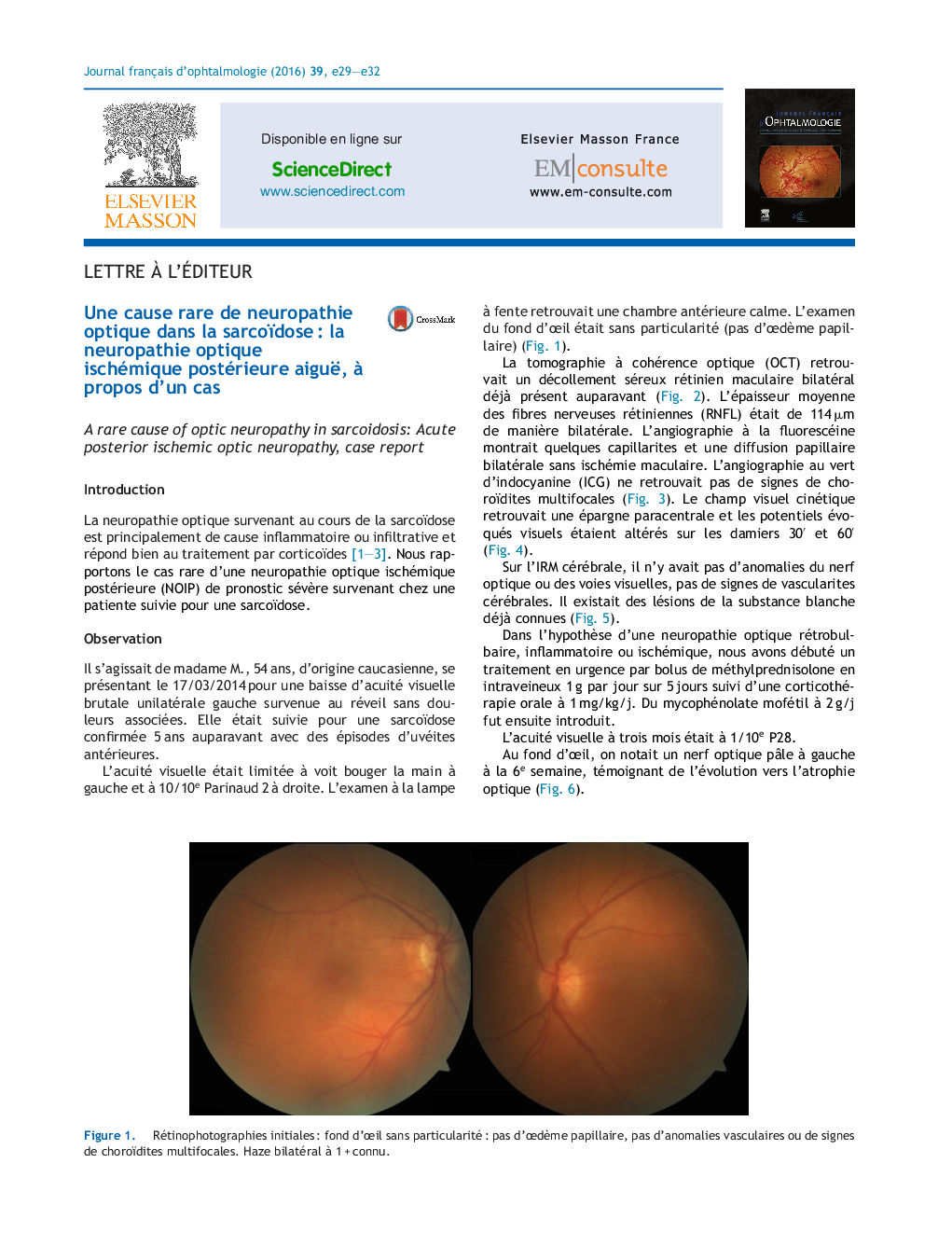 Une cause rare de neuropathie optique dans la sarcoïdoseÂ : la neuropathie optique ischémique postérieure aiguë, Ã  propos d'un cas