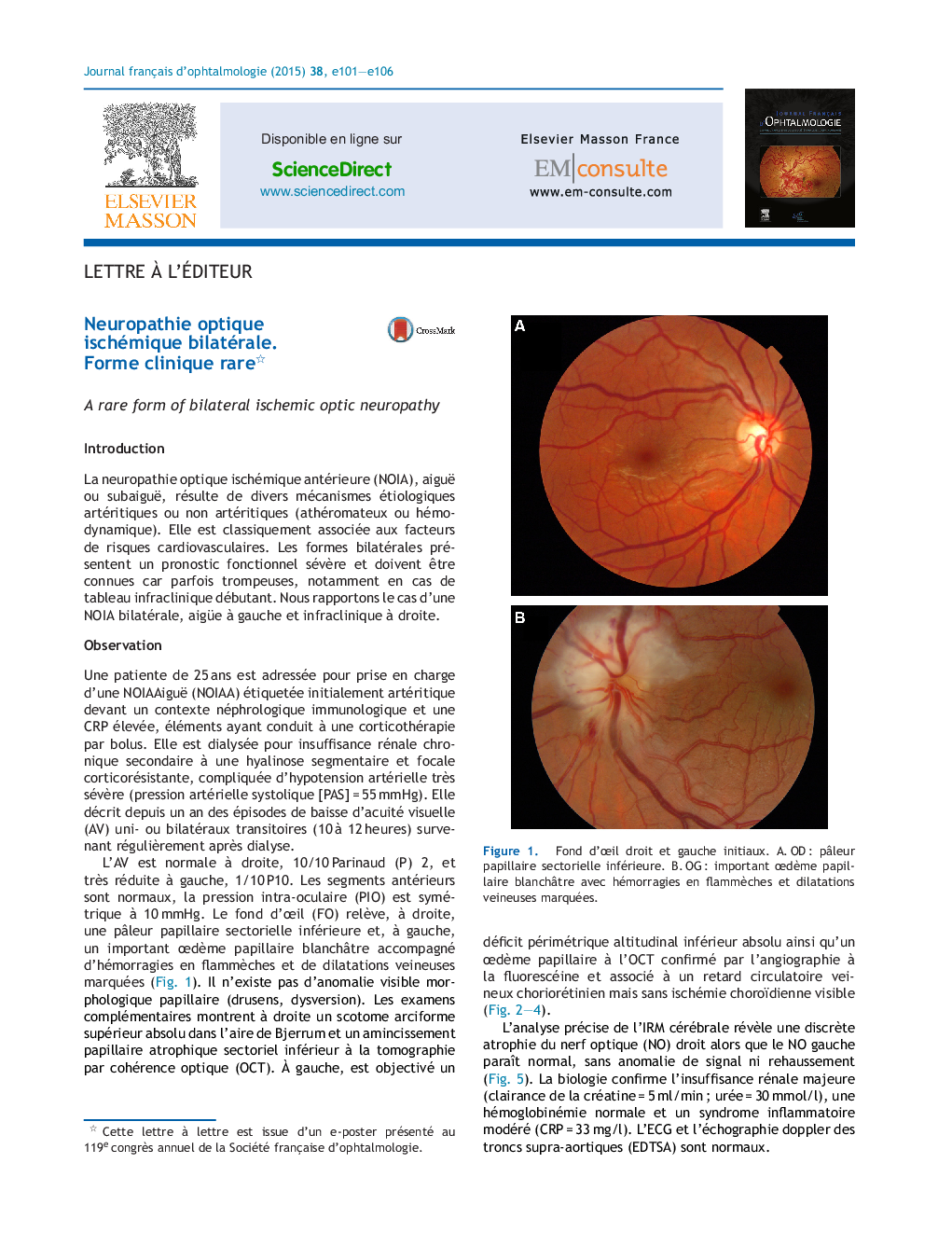 Neuropathie optique ischémique bilatérale. Forme clinique rare