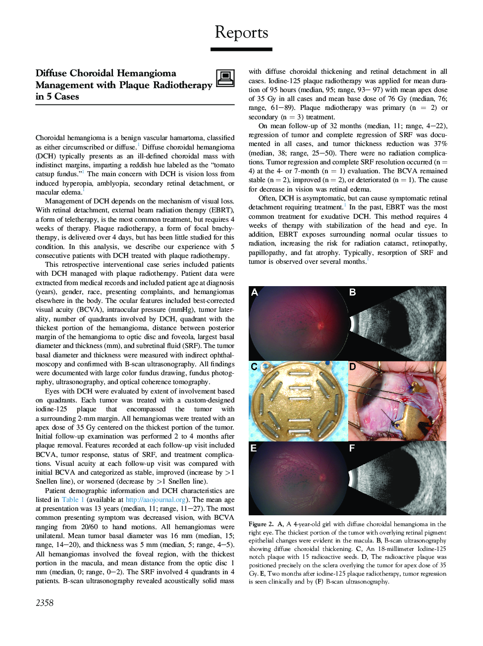 عکس صفحه اول مقاله: Diffuse Choroidal Hemangioma Management with Plaque Radiotherapy in 5 Cases Diffuse Choroidal Hemangioma Management with Plaque Radiotherapy in 5 Cases