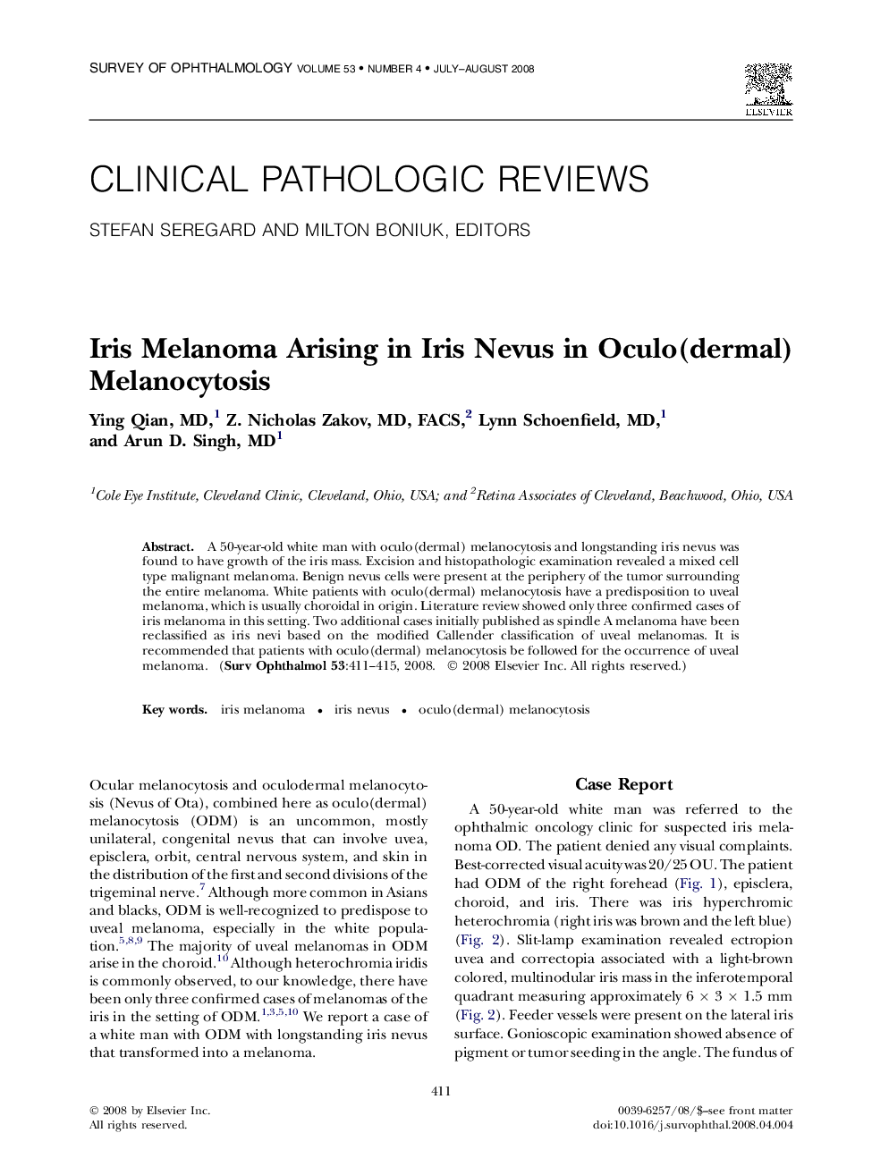 Iris Melanoma Arising in Iris Nevus in Oculo(dermal) Melanocytosis 