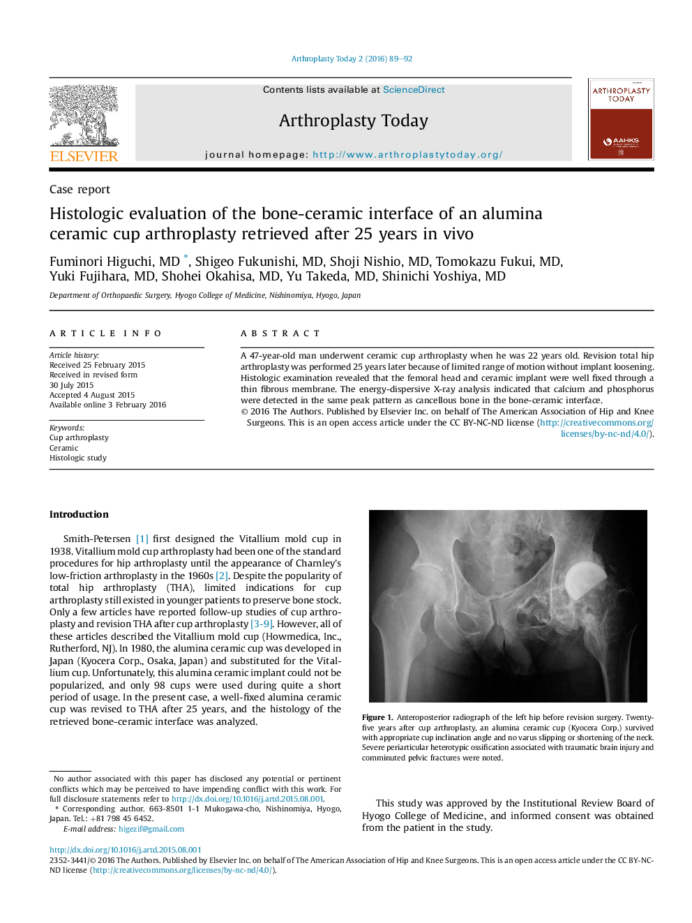 Histologic evaluation of the bone-ceramic interface of an alumina ceramic cup arthroplasty retrieved after 25 years inÂ vivo