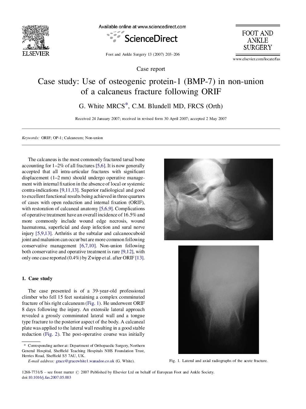 Case study: Use of osteogenic protein-1 (BMP-7) in non-union of a calcaneus fracture following ORIF