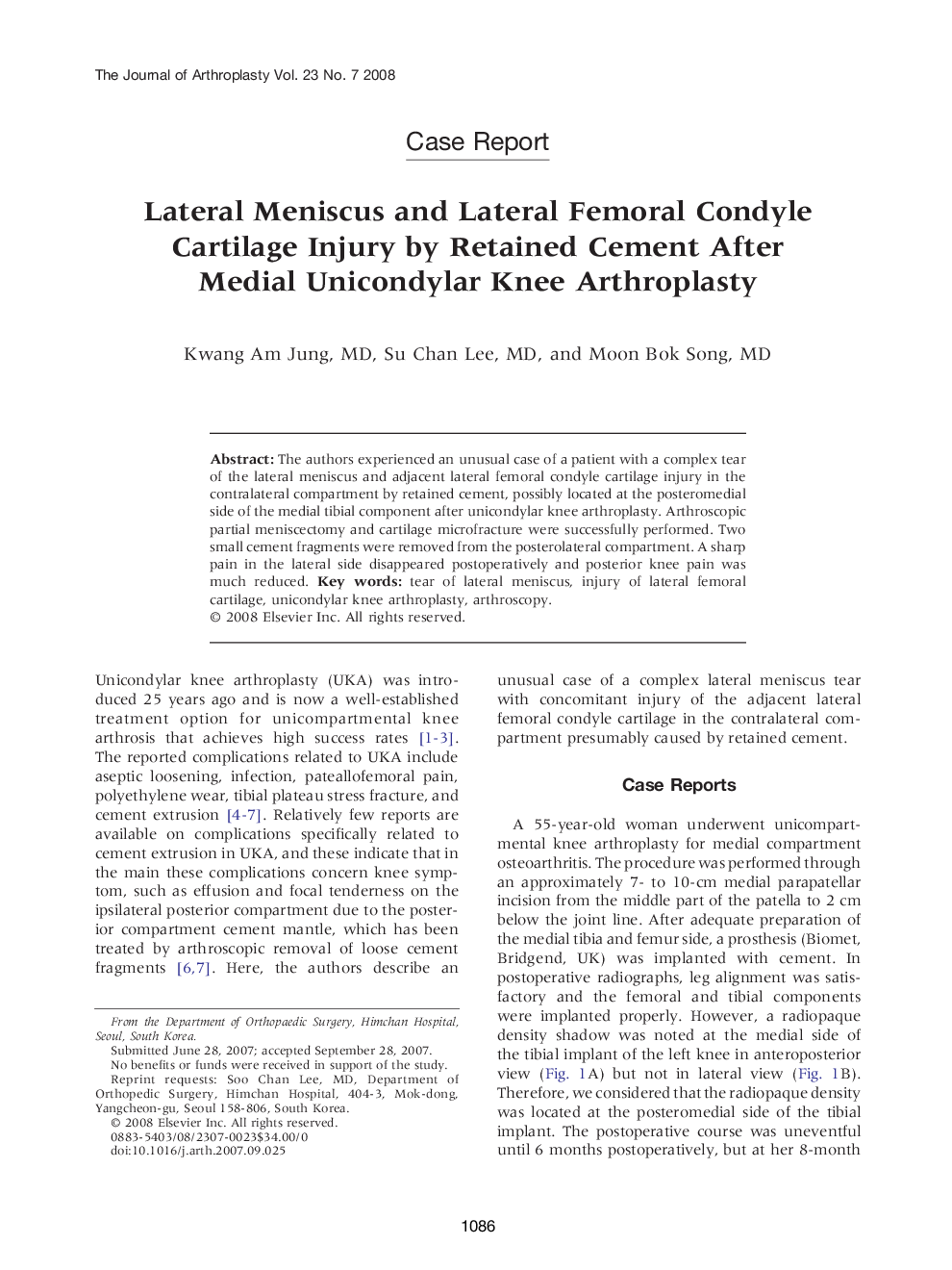 Lateral Meniscus and Lateral Femoral Condyle Cartilage Injury by Retained Cement After Medial Unicondylar Knee Arthroplasty 