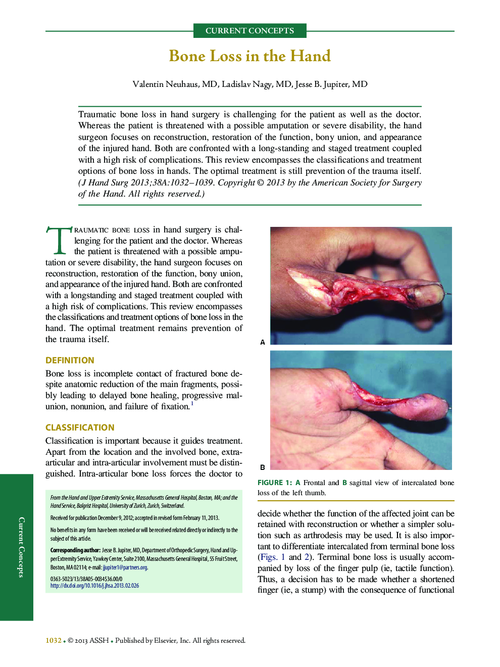 Bone Loss in the Hand 