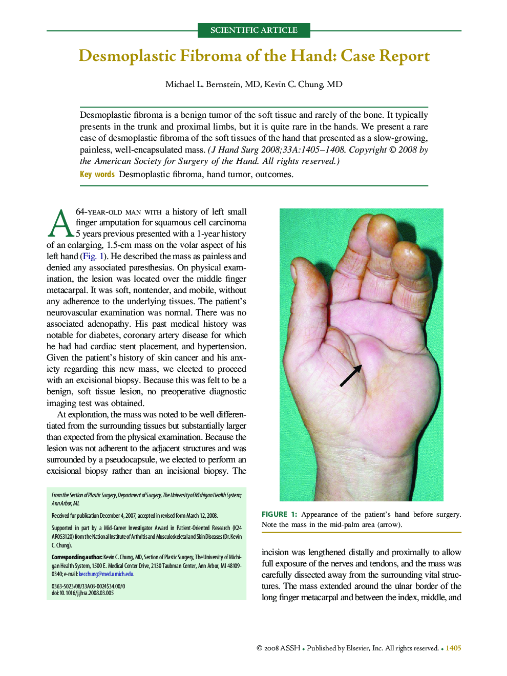 Desmoplastic Fibroma of the Hand: Case Report 