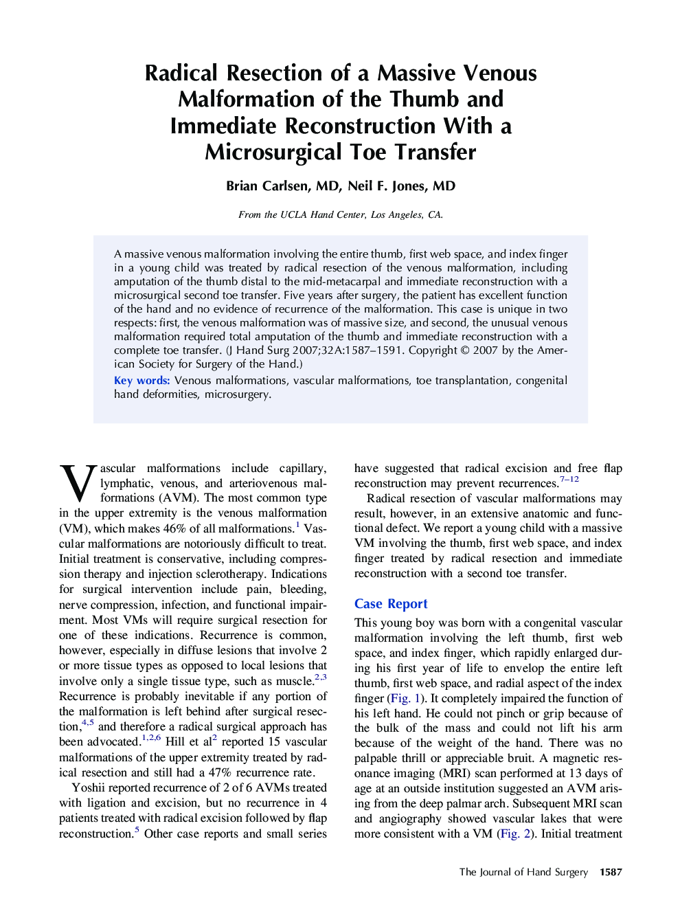 Radical Resection of a Massive Venous Malformation of the Thumb and Immediate Reconstruction With a Microsurgical Toe Transfer 