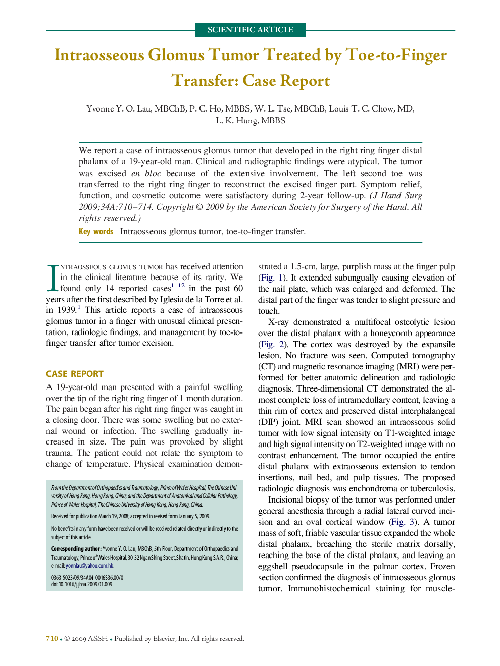Intraosseous Glomus Tumor Treated by Toe-to-Finger Transfer: Case Report