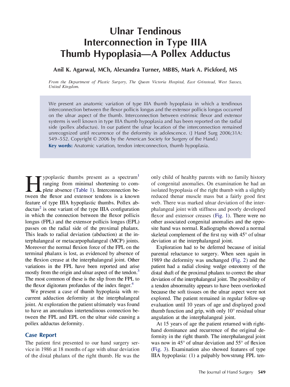 Ulnar Tendinous Interconnection in Type IIIA Thumb Hypoplasia—A Pollex Adductus 