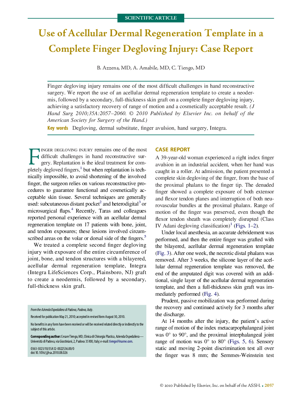 Use of Acellular Dermal Regeneration Template in a Complete Finger Degloving Injury: Case Report 