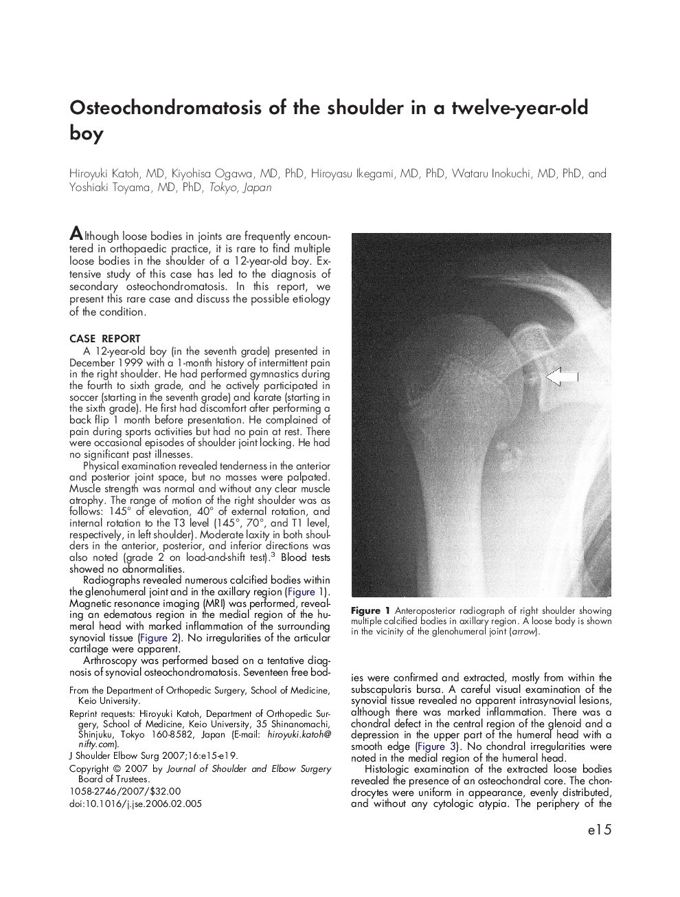 عکس صفحه اول مقاله: Osteochondromatosis of the shoulder in a twelve-year-old boy Osteochondromatosis of the shoulder in a twelve-year-old boy