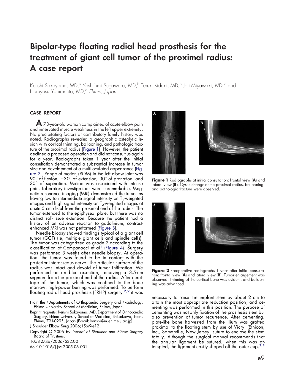 Bipolar-type floating radial head prosthesis for the treatment of giant cell tumor of the proximal radius: A case report